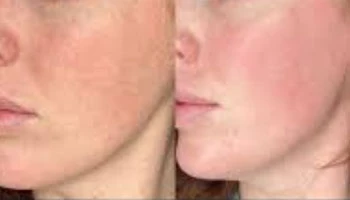 Thulium Laser PL Kliniken